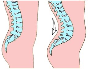 درمان قوس کمر یا گودی کمر