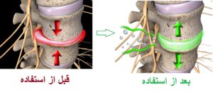 درمان دیسک کمر