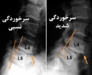 درمان سرخوردگی مهر با دستگاه T1