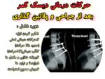 حرکات درمانی بعد از جراحی دیسک کمر