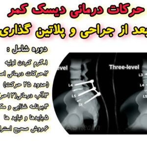 حرکات درمانی بعد از جراحی دیسک کمر