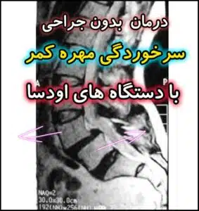 سرخوردگی مهره