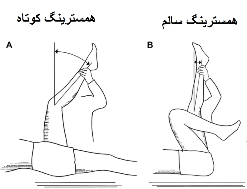 درمان کوتاهی همسترینک با دستگاه کشش همسترینگ اودسا