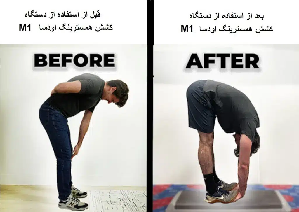 درمان کوتاهی همسترینگ با دستگاه اودسا